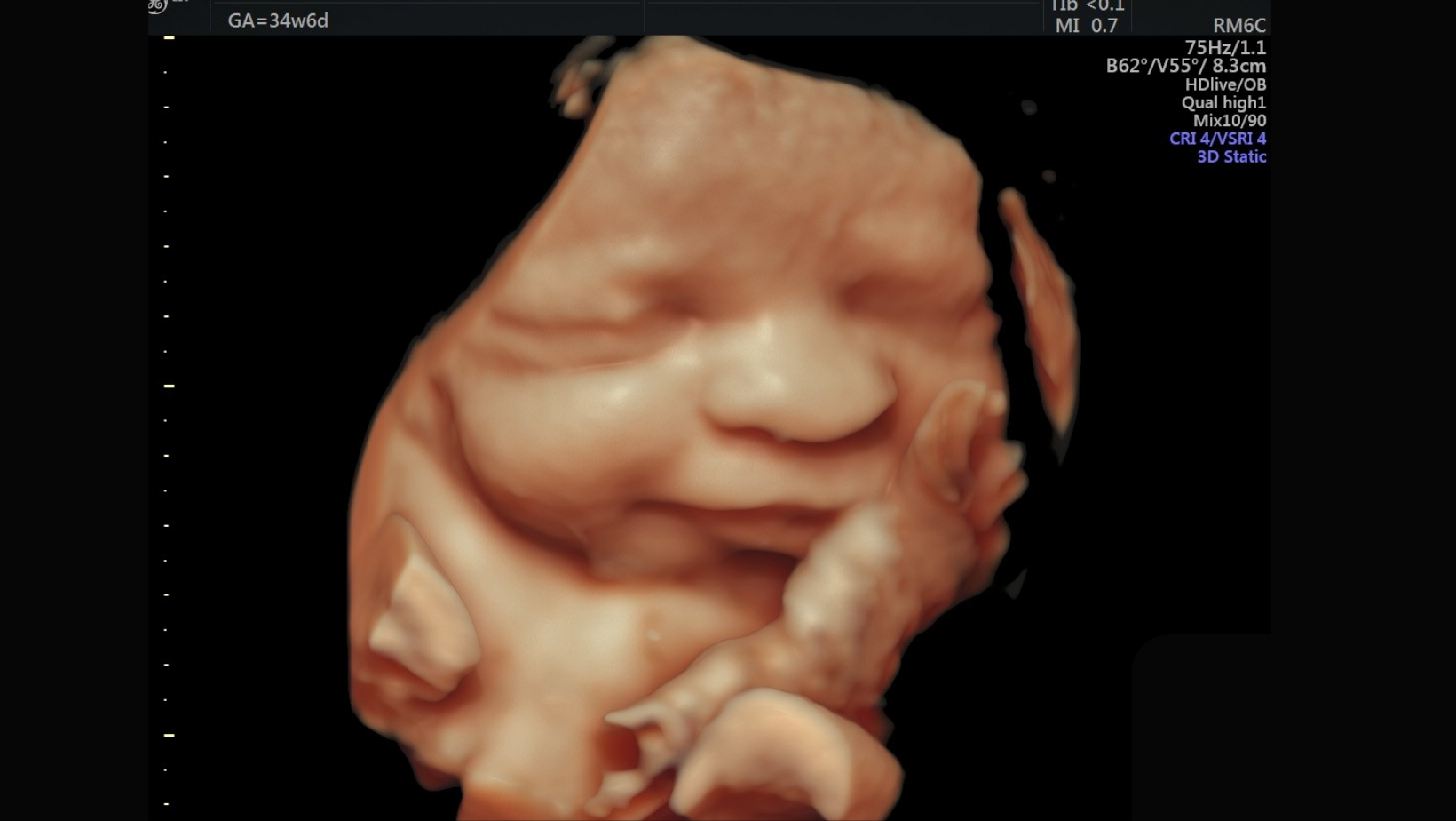 Ultrasound 3D