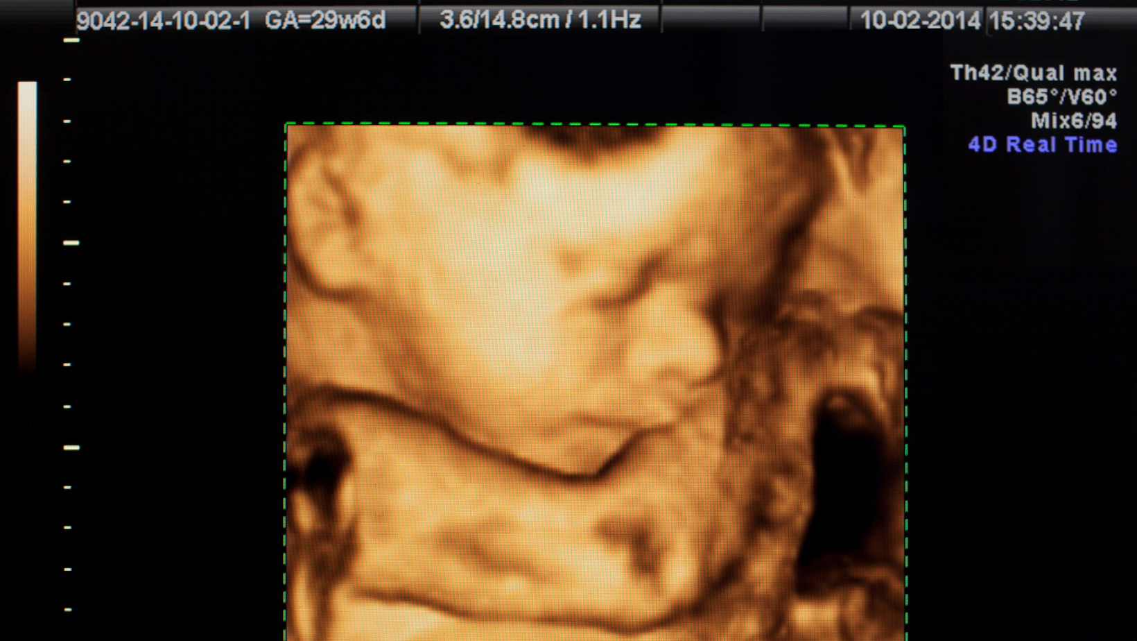 Ultrasound 4D